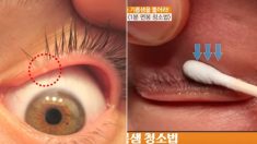렌즈 자주 끼는 사람들 ‘안구건조증’ 예방해주는 ‘눈 기름샘 짜기’ (영상)
