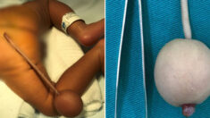 엉덩이에 ‘공 달린 12cm 꼬리’ 달고 태어나 의료진 놀라게 한 브라질 아기