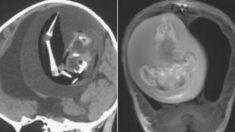 “아기 머리가 너무 커요” 두개골 열어 보니 ‘쌍둥이 태아’ 자라고 있었다